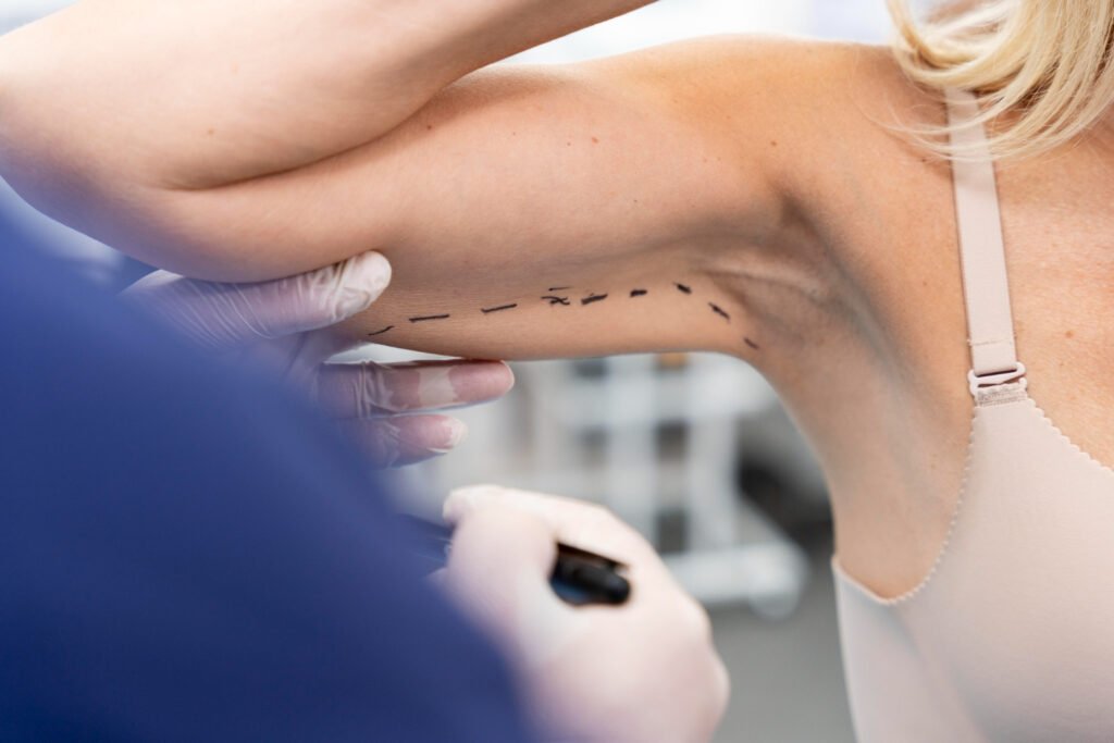Recovery After Brachioplasty